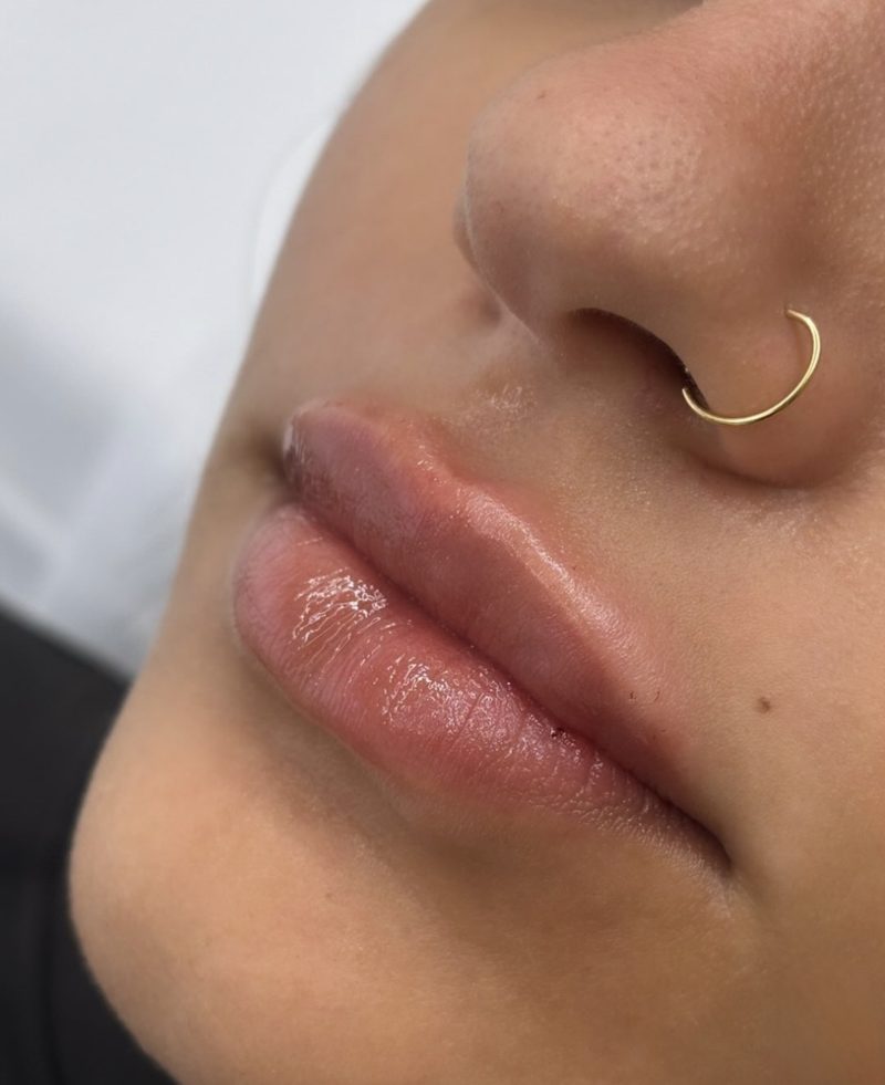 Resultado de preenchimento labial com contorno definido