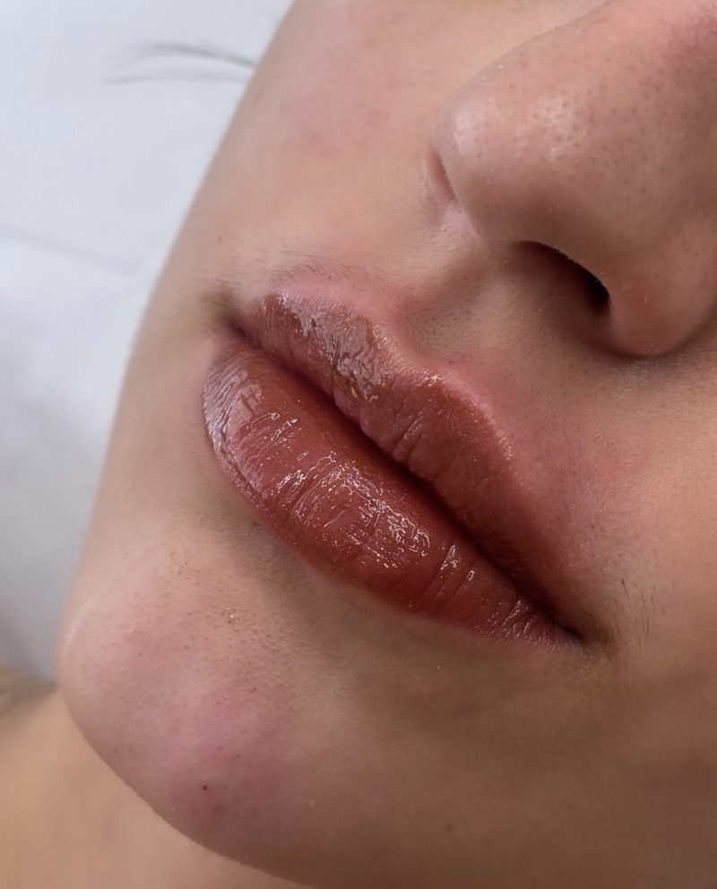 Resultado de preenchimento labial natural