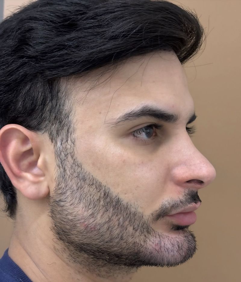 Harmonização facial masculina, vista de perfil